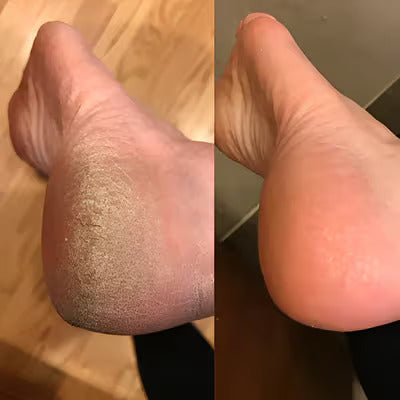 SilkySole™ Electric Foot File